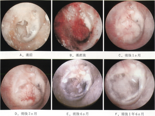 再生 鼓膜 薬で鼓膜の再生促す外来で治療が可能に（慶応大学病院耳鼻咽喉科 神崎晶専任講師）｜医療ニュース